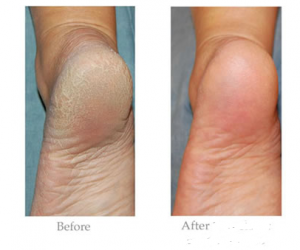 العناية بالقدمين