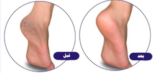 العناية بالقدمين