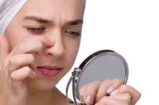 طرق طبيعية لإزالة الرؤوس السوداء