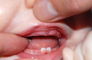 علامات التسنين عند الأطفال